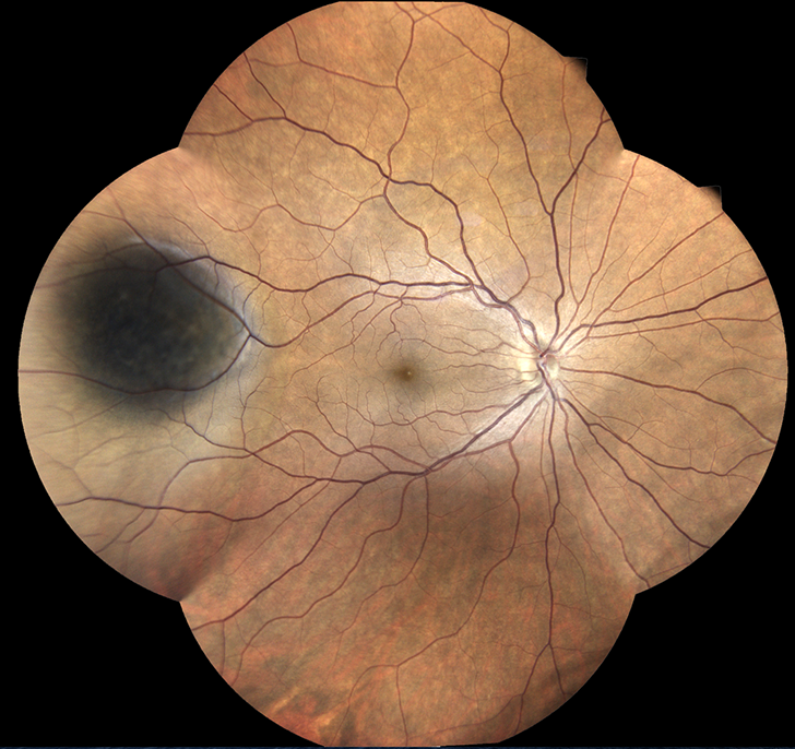 fundus
