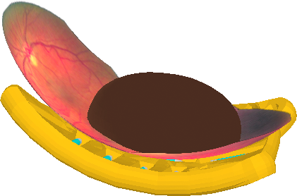 TumorOpaque