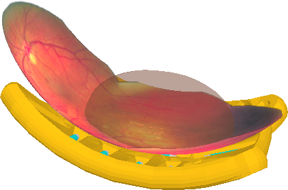 TumorTranslucent