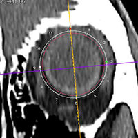 CoronalTool