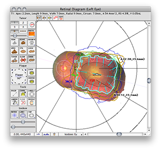 IT22RetinaDosimetry