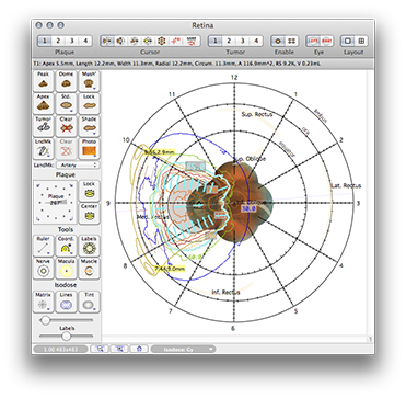 PP151RetinaDosimetry