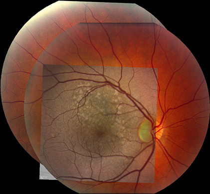 Fundus fusion