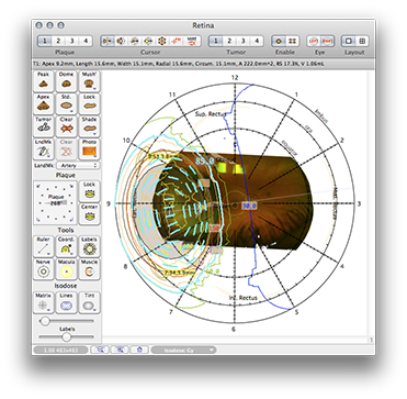 TT139RetinaDosimetry